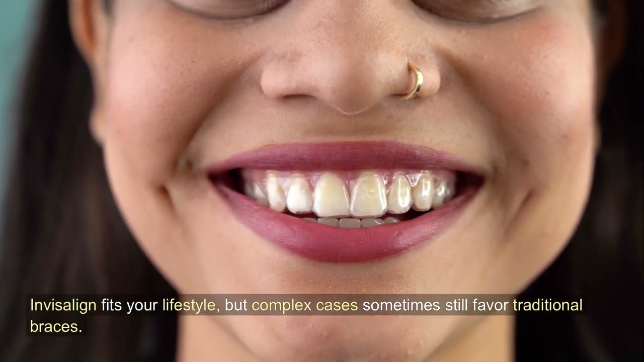 Straighter Teeth Without Metal: Is Invisalign the Right Call for You?