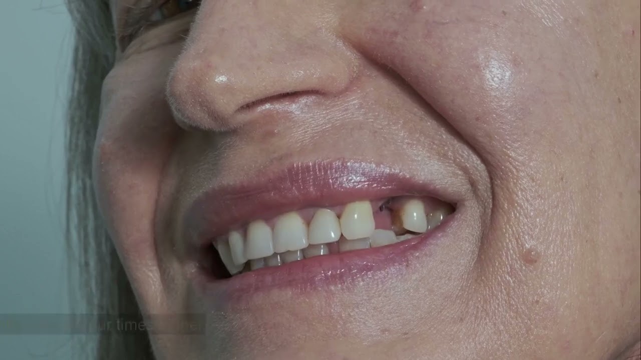 Red Flags That Mean You Need a Dental Crown Immediately