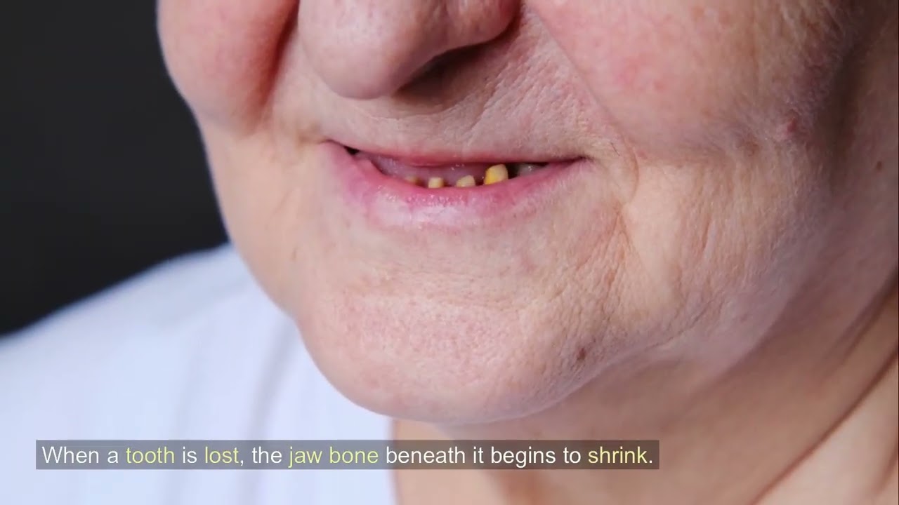 Do You Need Bone Grafting or a Sinus Lift Before Dental Implants?