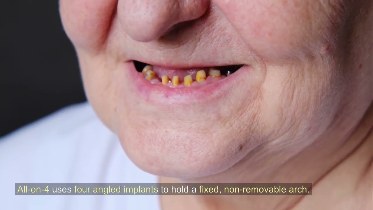 All-on-4 vs. Implant-Supported Dentures: Which Option Is Right for You?