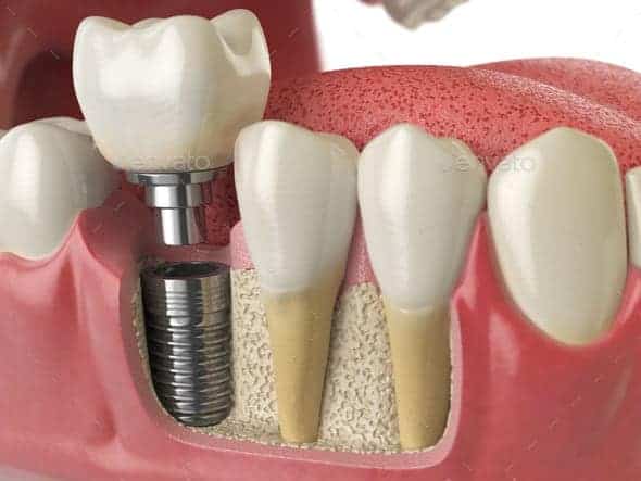 Advanced dental implant technology at North County Dental Care Encinitas