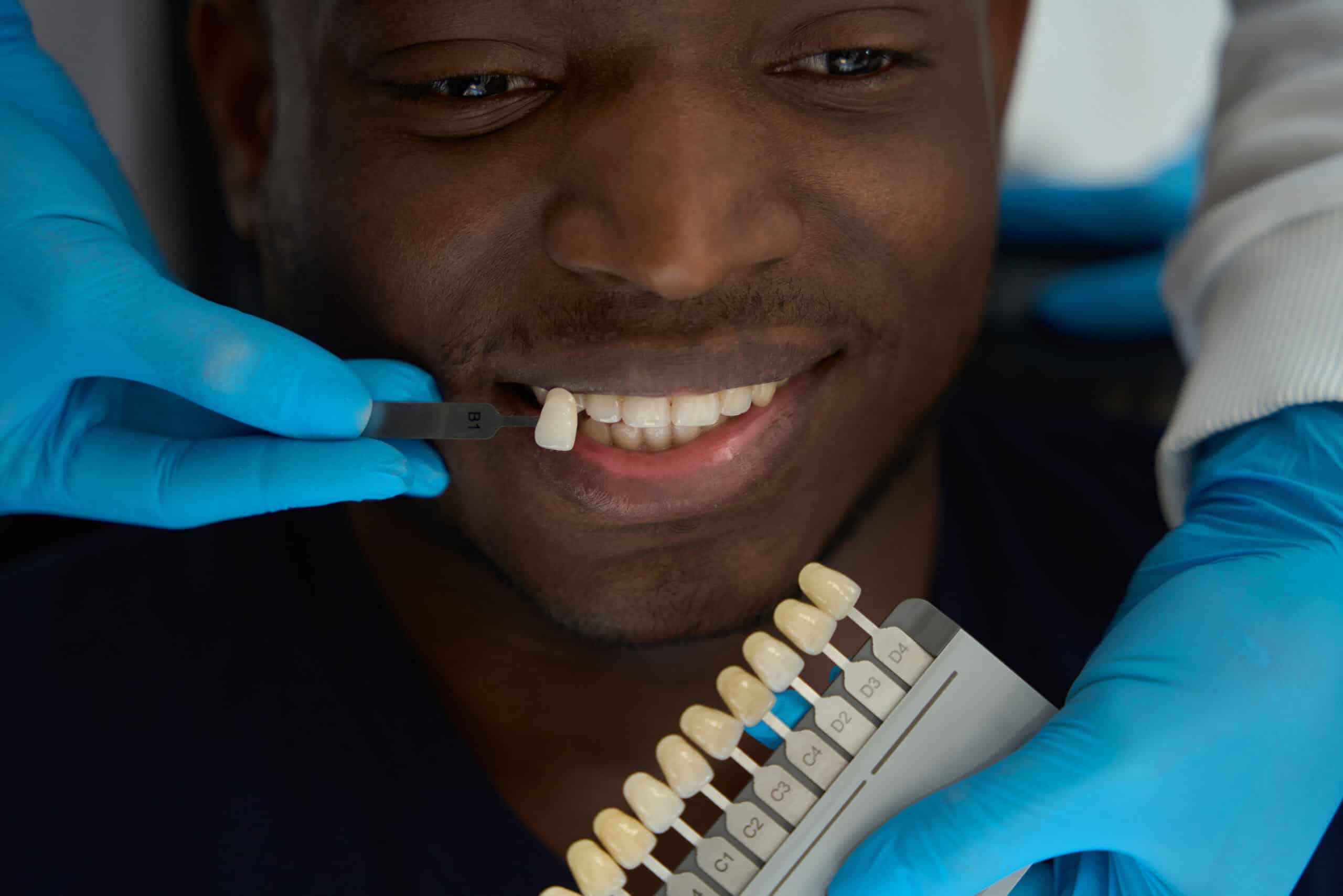 Dental Veneers Oceanside, CA